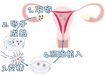 42岁二胎案例